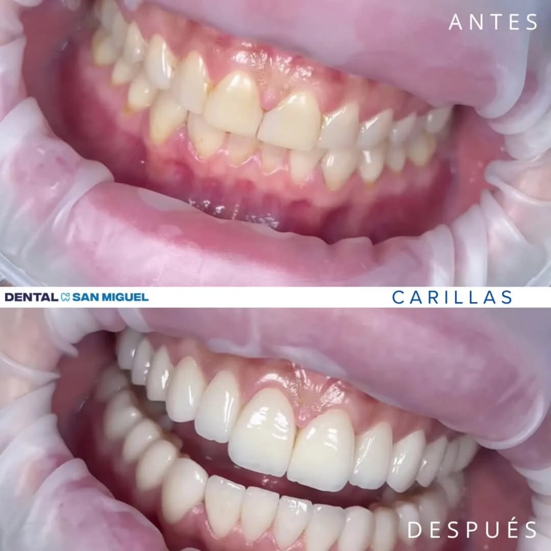 Caso real carillas de porcelana E-max — Antes y Después — Dental San Miguel